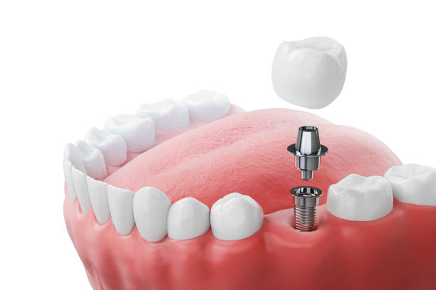 Modernūs sprendimai dantų implantams ir protezavimui Kaune jūsų šypsenai