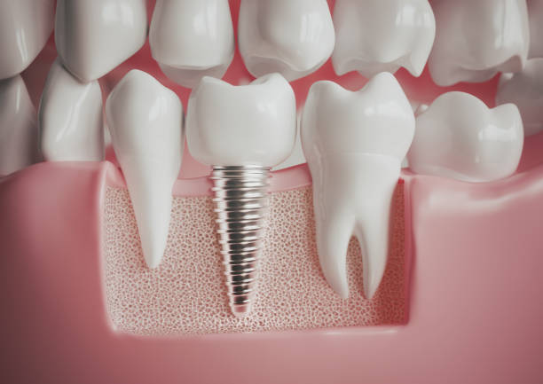 Dantų implantacija: nuo baimės iki naujos šypsenos – pacientų patirtys ir šiuolaikinės technologijos